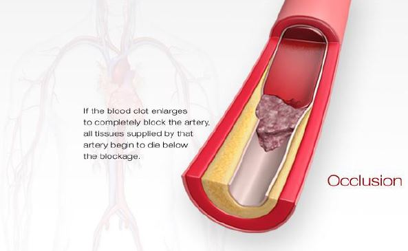 Artery Occlusuon