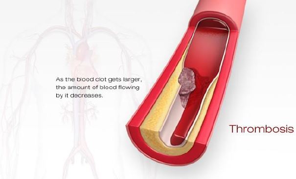 Artery Thrombosis